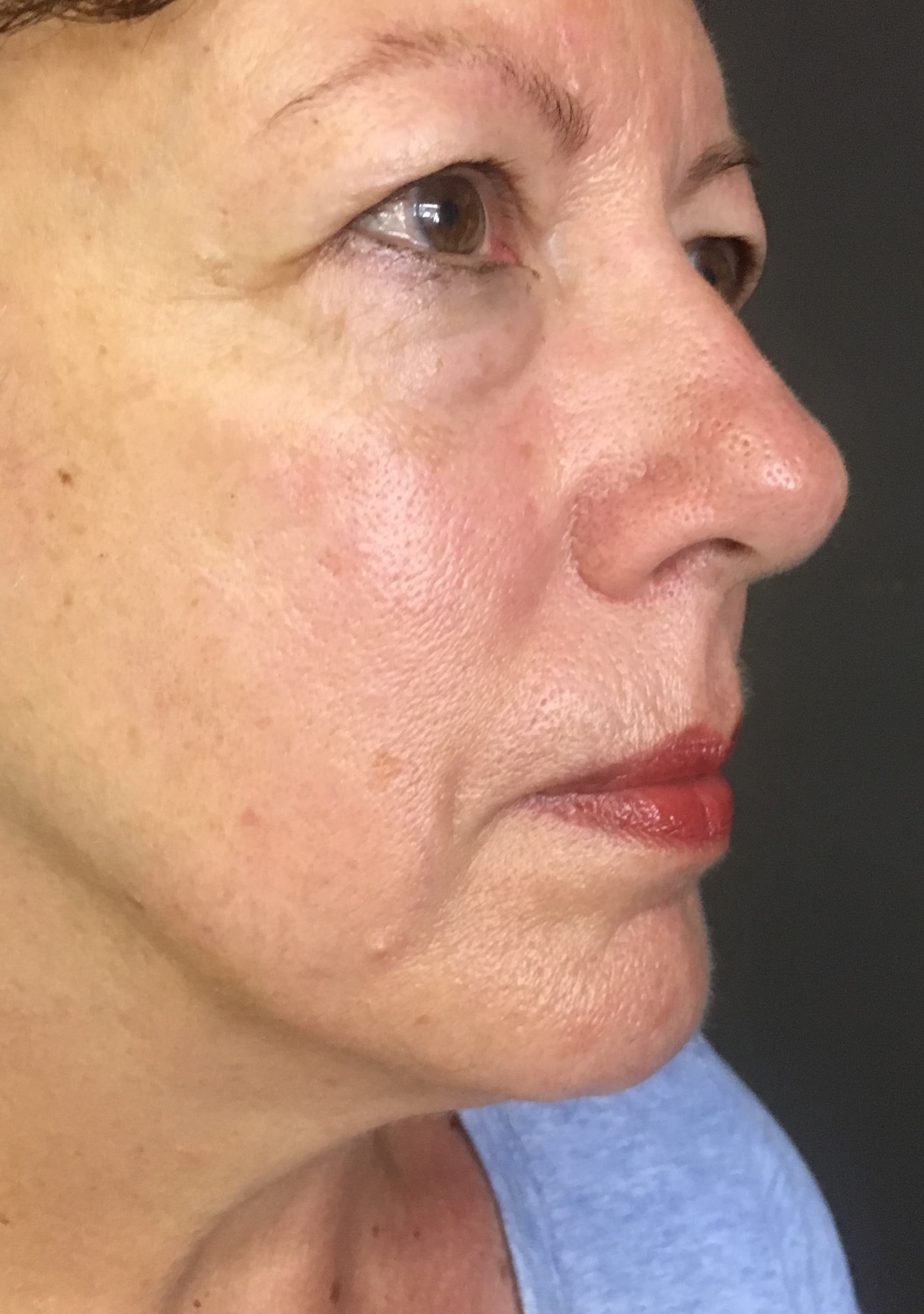 After image of cosmetic acupuncture at Silver Iris Clinic in Los Gatos, CA