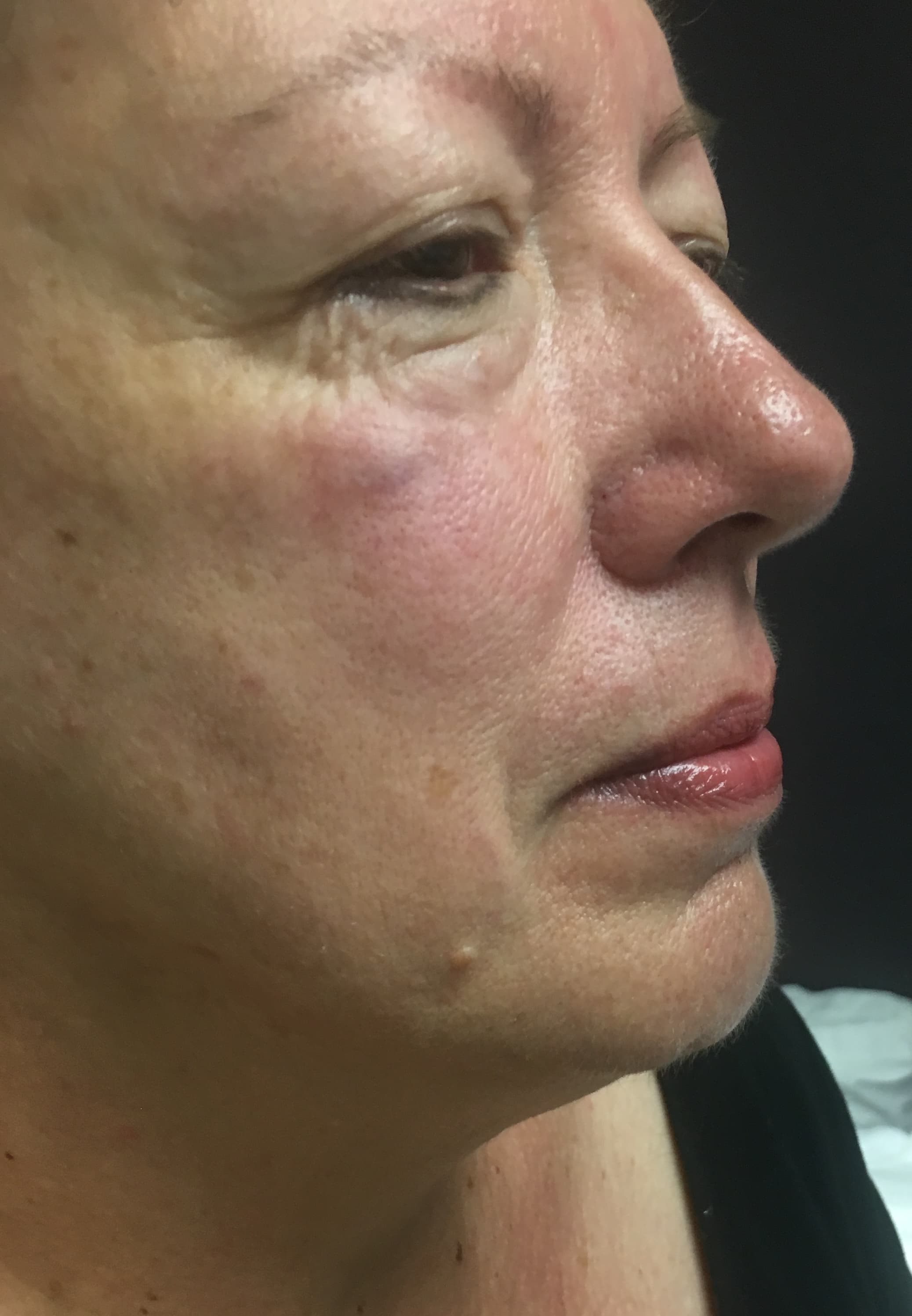 Before image of cosmetic acupuncture at Silver Iris Clinic in Los Gatos, CA